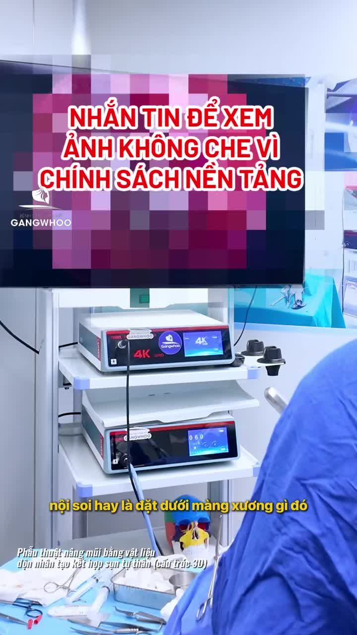 Hành trình say bye chiếc mũi thấp tẹt để sở hữu dáng mũi tỷ lệ vàng