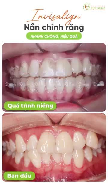 Chọn Invisalign, chọn hành trình chỉnh nha nhẹ nhàng, hiệu quả!