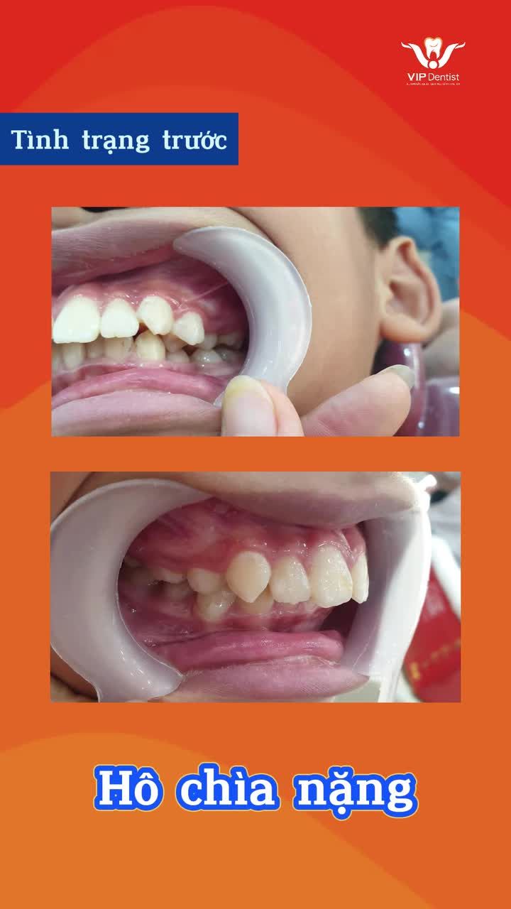 LỘT XÁC NGOẠN MỤC: TẠM BIỆT HÔ CHÌA – CHẲNG CẦN NHỔ RĂNG!