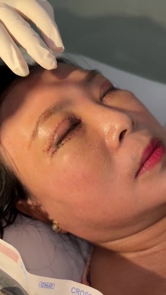 HẾT HỒN: Quý cô Miền Tây U50 TRẺ LIỀN 10 TUỔI sau Combo Trẻ hoá đôi mắt toàn diện