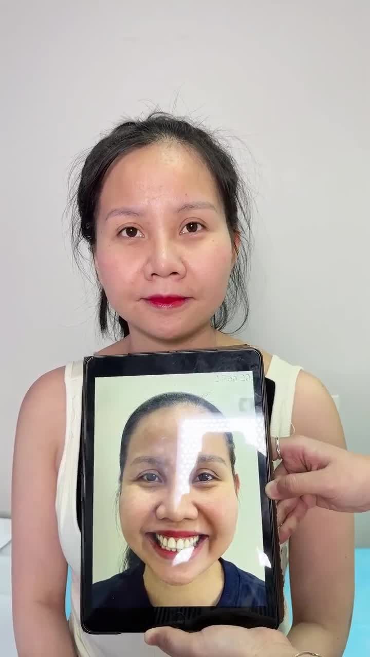 HOT: Hơn 30 năm tự ti, cô gái 9X hoá nàng thơ cực xinh sau PHẪU THUẬT HÀM HÔ tại JW