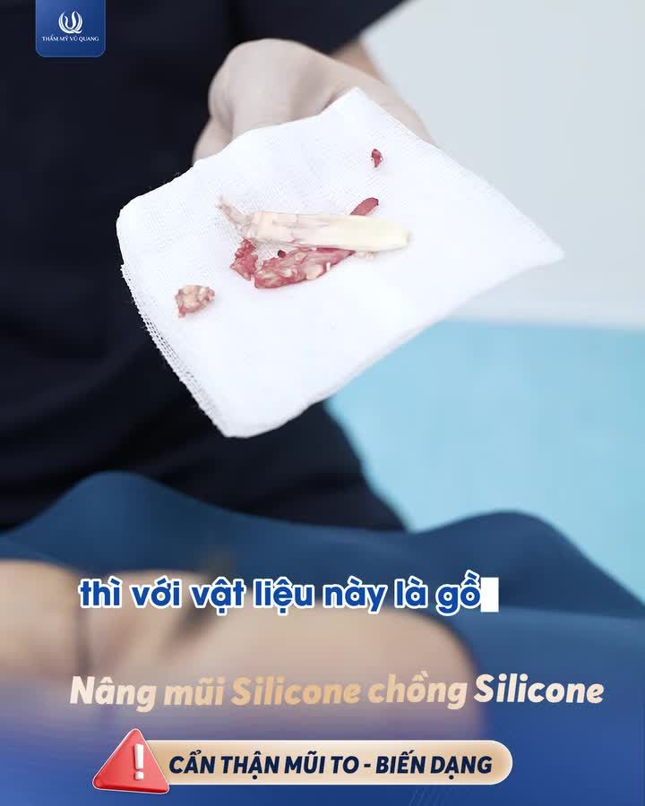 NÂNG MŨI TÁN BỘT: ĐẸP ĐÂU KHÔNG THẤY, CHỈ THẤY... BIẾN DẠNG!