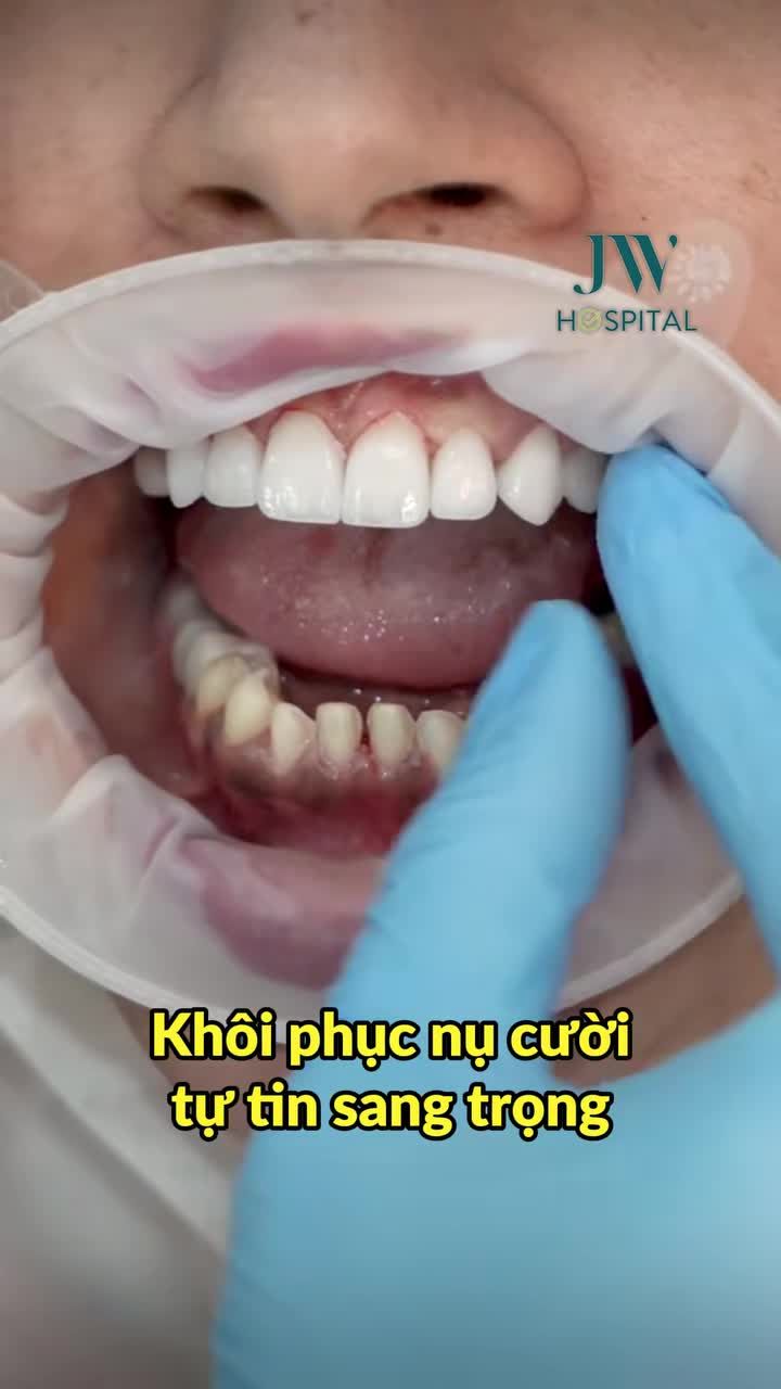 BỌC RĂNG SỨ: GIẢI PHÁP VÀNG CHO NỤ CƯỜI ĐẸP SANG HOÀN HẢO