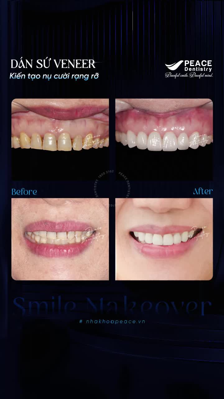 Xem thêm 10 video Mặt Dán Sứ Veneer của bác sĩ Bs nha khoa Peace Dentistry