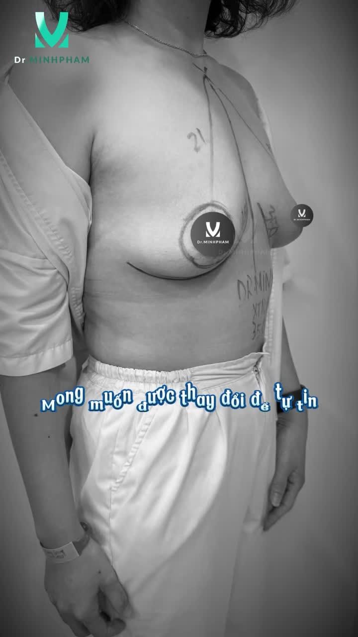 Cập nhật ngay kết quả của ca nâng cấp V1 tại Dr. Minh Phạm