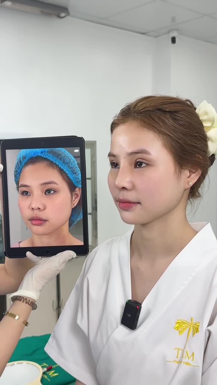 Khách hàng tới tái khám và cắt chỉ sau 10 ngày Nâng mũi.