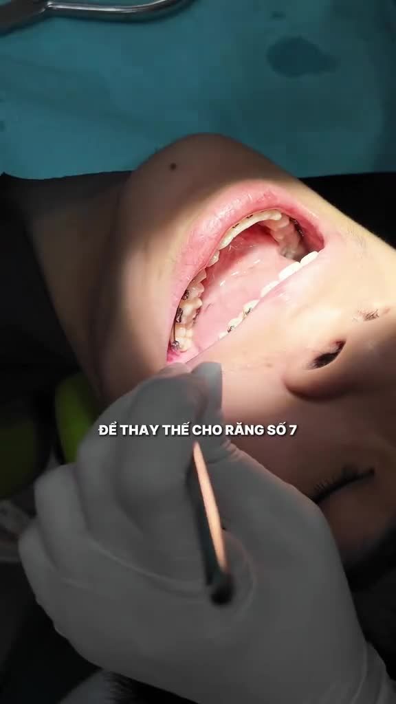 Niềng răng kéo răng khôn thay thế răng hàm đã mất: Giải pháp tối ưu giúp bạn giữ trọn răng thật mà không cần trồng Implant!