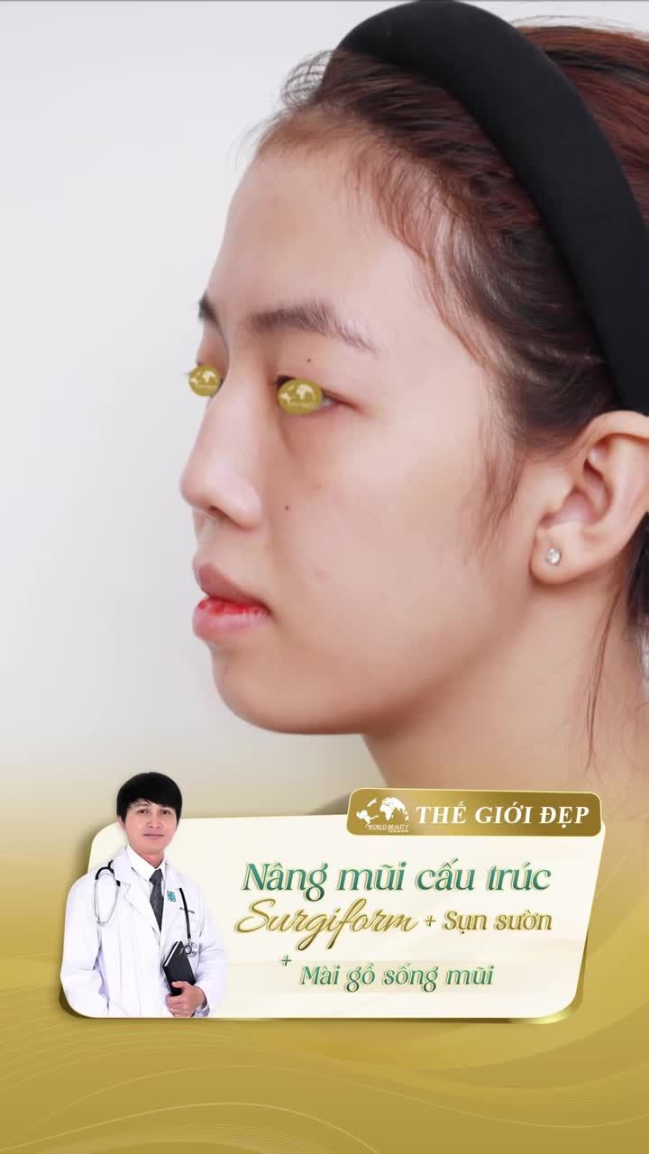 NÂNG MŨI CẤU TRÚC KẾT HỢP CHỈNH GỒ SỐNG MŨI – Trả lại dáng mũi thanh thoát, hài hòa
