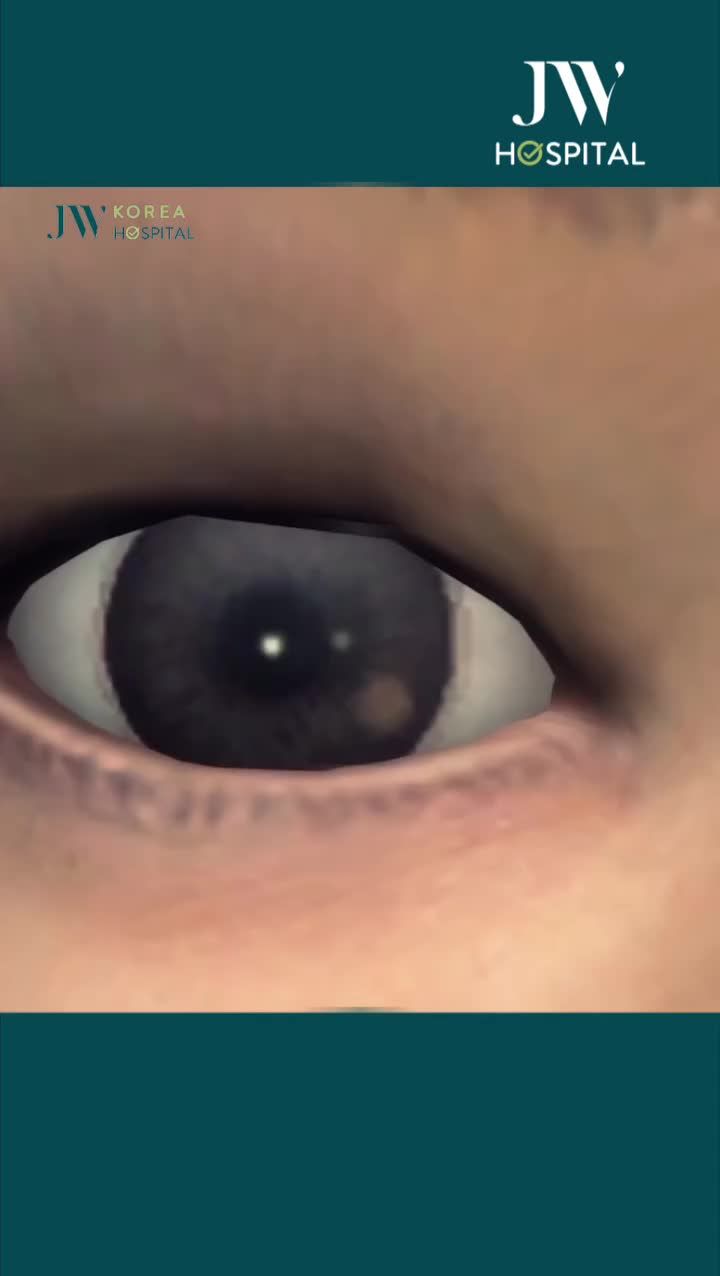 GIẢI PHÁP GIÚP BẠN SỞ HỮU ĐÔI MẮT 2 MÍ TO TRÒN, LONG LANH TẠI JW