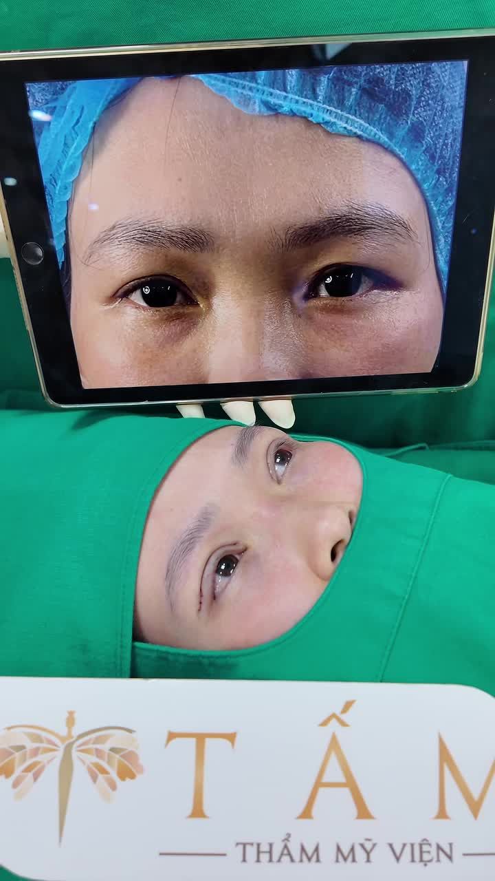 Mắt cụp buồn, mí lót không còn là nỗi lo!