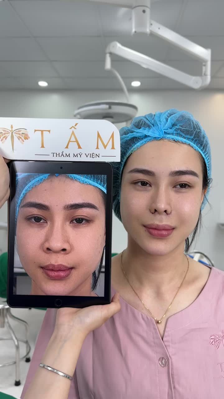 Thay đổi nhỏ, khác biệt lớn với dịch vụ Thu gọn cánh mũi tại TMV Tấm