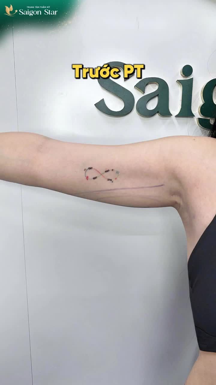 HÚT MỠ BẮP TAY ÁO HAI DÂY KHÔNG CÒN LÀM KHÓ ĐƯỢC SỰ THON GỌN NÀY!!!