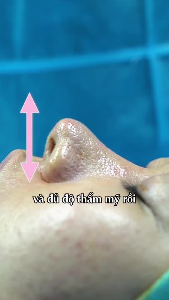 “Không phải ai cũng cần nâng mũi cấu trúc đâu.”