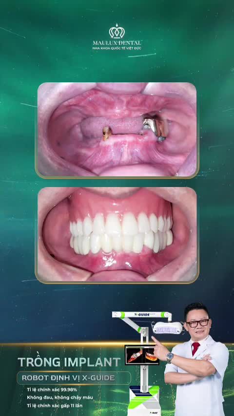 Mất răng nhiều năm và thay đổi bất ngờ sau trồng Implant