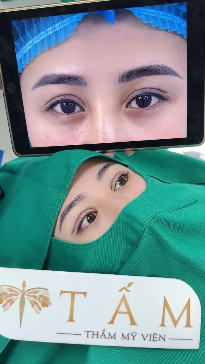 Trót tin nhầm spa kém uy tín khiến nếp mí quá to và sâu làm gương mặt già đi cả chục tuổi.
