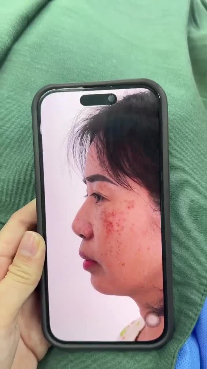 KẾT QUẢ SAU 60 PHÚT NÂNG MŨI CẤU TRÚC - SỬA LẠI MŨI HỎNG KH. MỸ QUYÊN (CẦN THƠ)