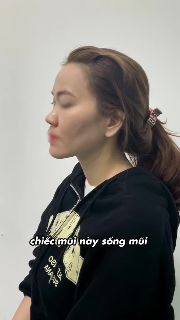 Nâng mũi cấu trúc sụn tai – đẹp tự nhiên và ổn định