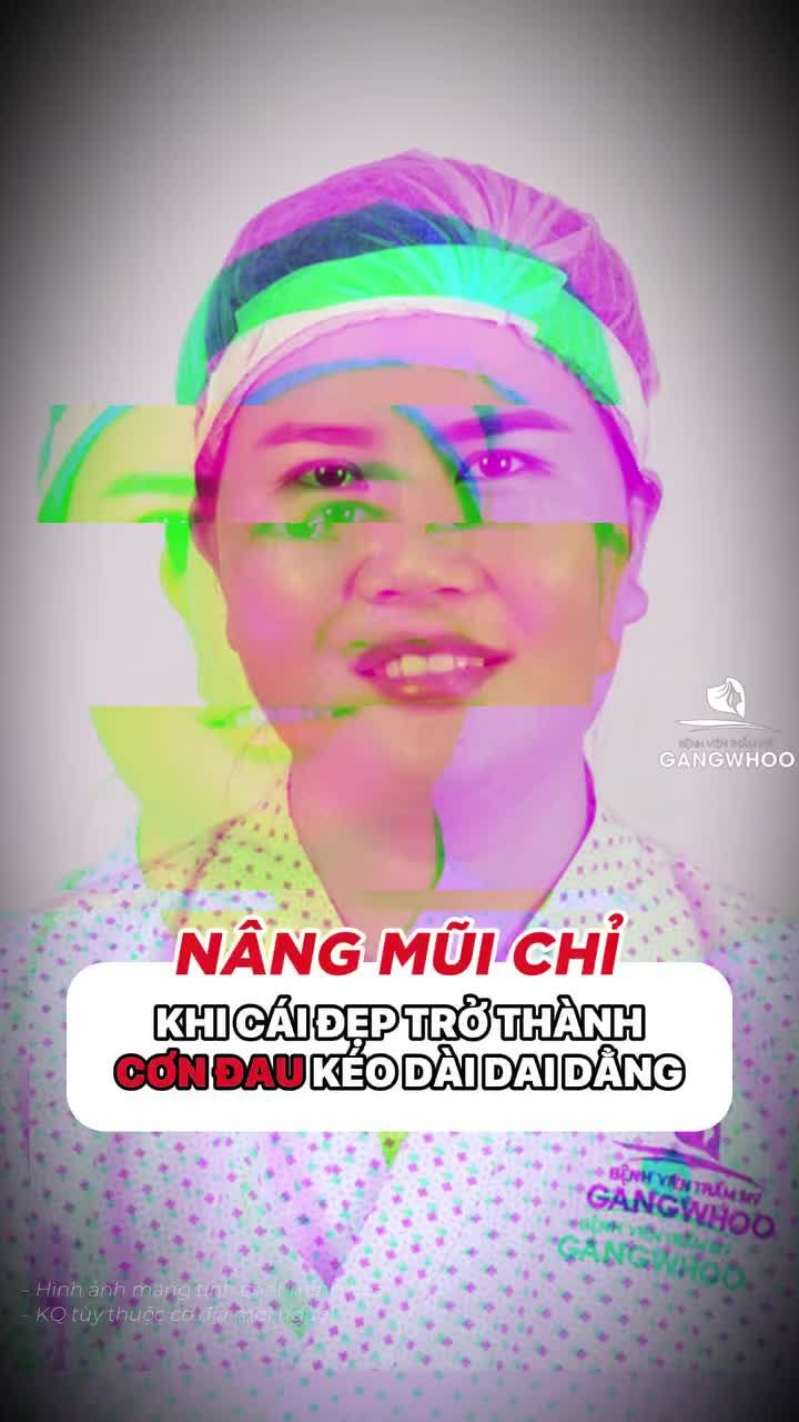 Nâng mũi chỉ - Khi làm đẹp trở thành đơn đau kéo dài dai dẳng