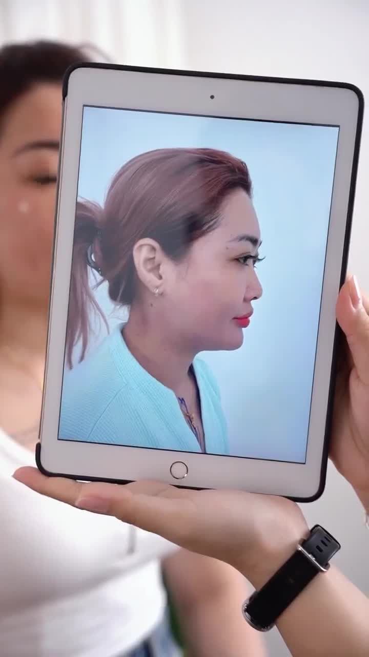 GẶP GỠ DÁNG MŨI CẤU TRÚC SAU 10 NGÀY KH. HOÀI TRANG ( NHA TRANG)