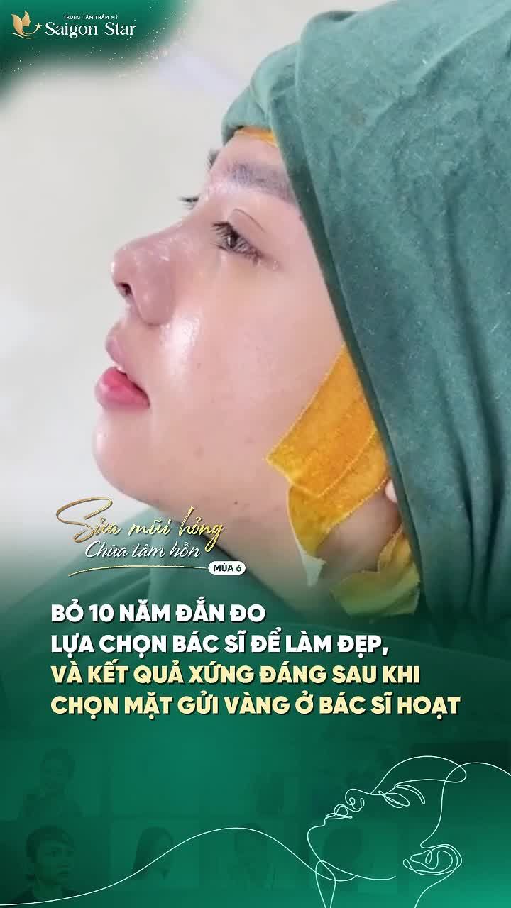 LỘT XÁC DIỆN MẠO SAU 10 NGÀY NÂNG MŨI CẤU TRÚC DR. HOẠT