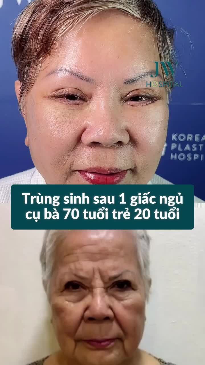 CHUYỆN LẠ CÓ THẬT: CỤ BÀ U70 TRẺ LẠI 20 TUỔI SAU 1 GIẤC NGỦ VỚI CĂNG DA MẶT SMAS TẠI JW
