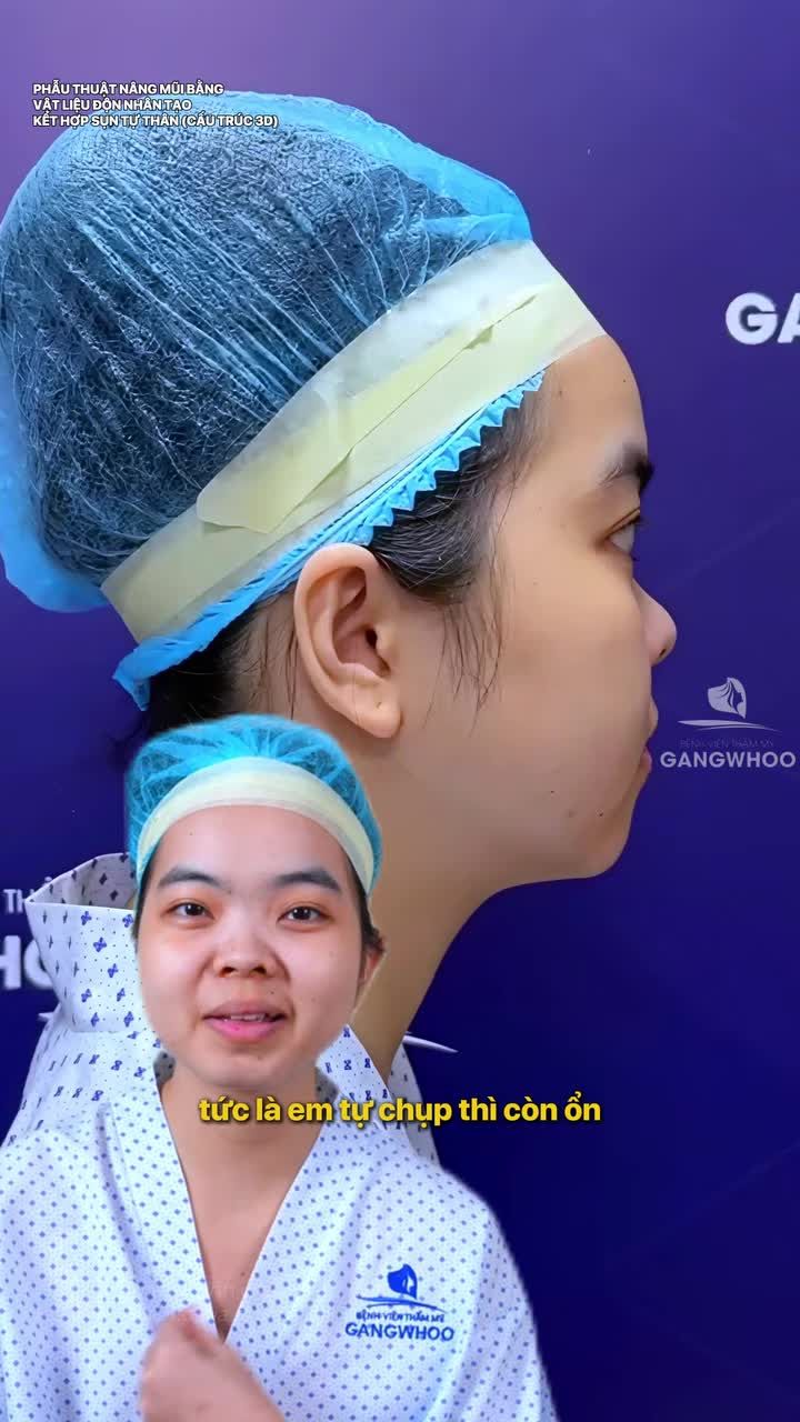 Nâng mũi để xinh đẹp tìm chồng như ý