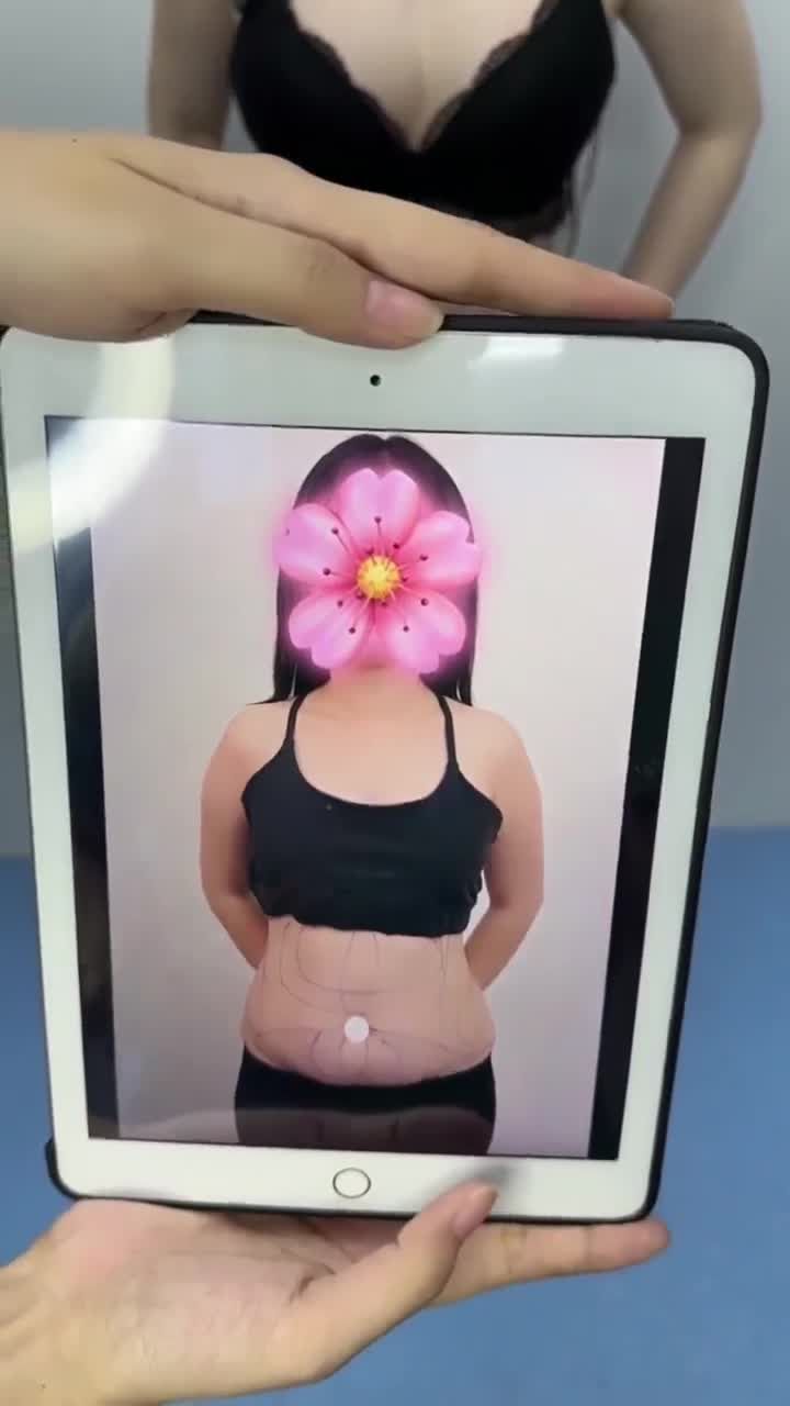 Review kết quả sau 3 tuần HÚT MỠ BỤNG 360° + CĂNG DA BỤNG