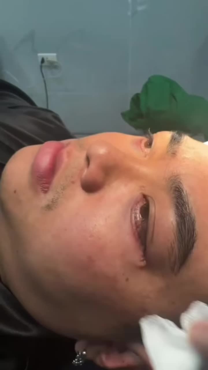 Combo xoá rãnh lệ sâu mí dưới với Dr Vương