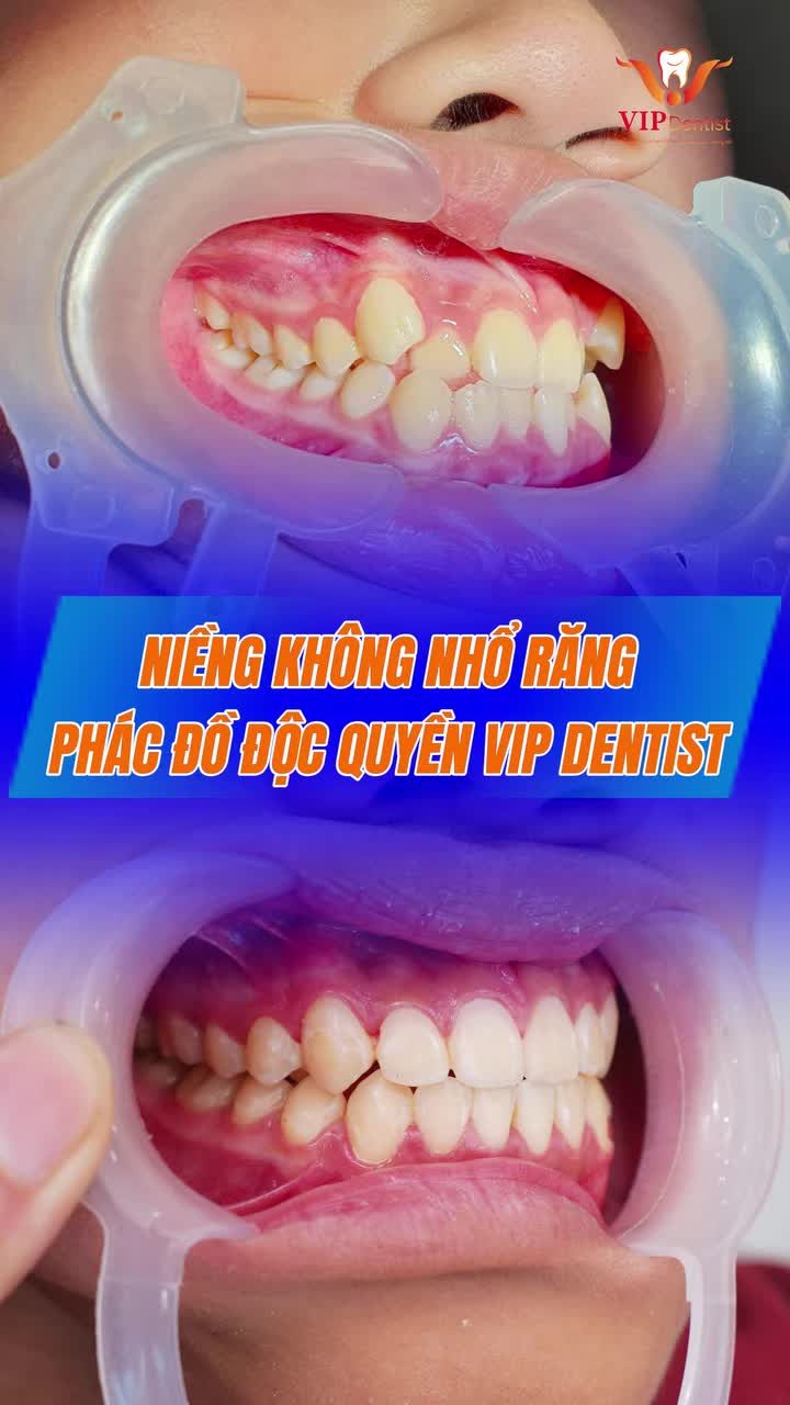 "CA NÀY CHẮC CHẮN PHẢI NHỔ RĂNG" - Đấy là vì bạn chưa biết đến Vip Dentist thôi!