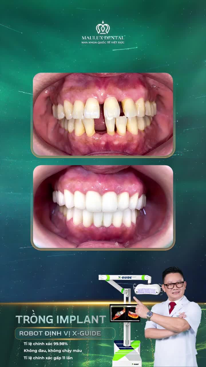Cô Phạm Thị Phương Lan thay đổi như nào sau khi trồng răng Implant