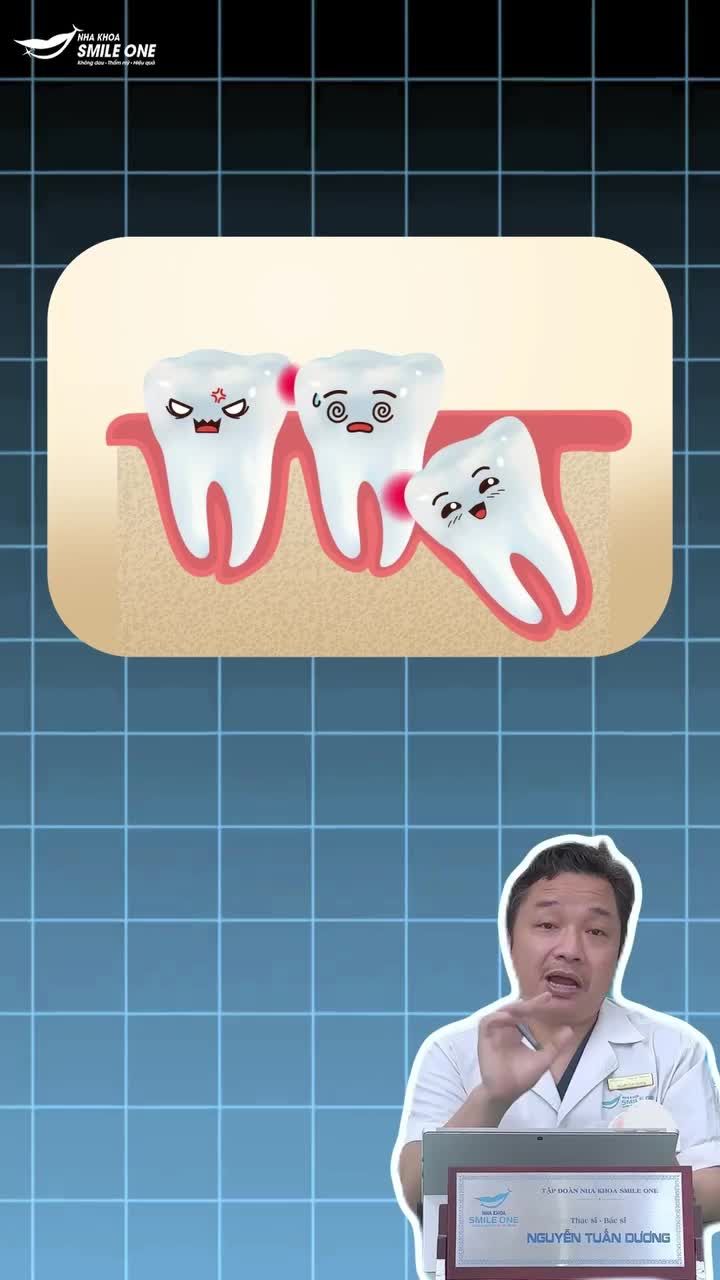 CẨN THẬN VỚI TÌNH TRẠNG RĂNG KHÔN MỌC NGẦM!