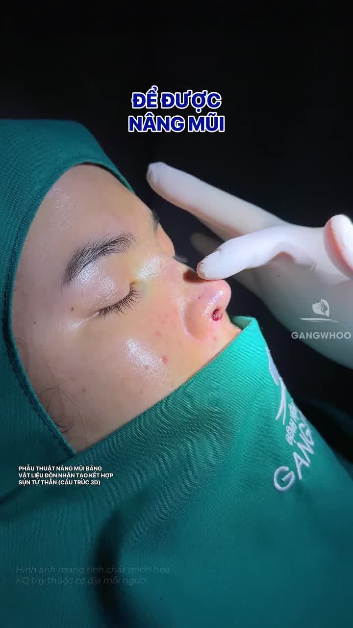 Đợi mãi mới đủ 18 tuổi để thực hiện ước mơ nâng mũi