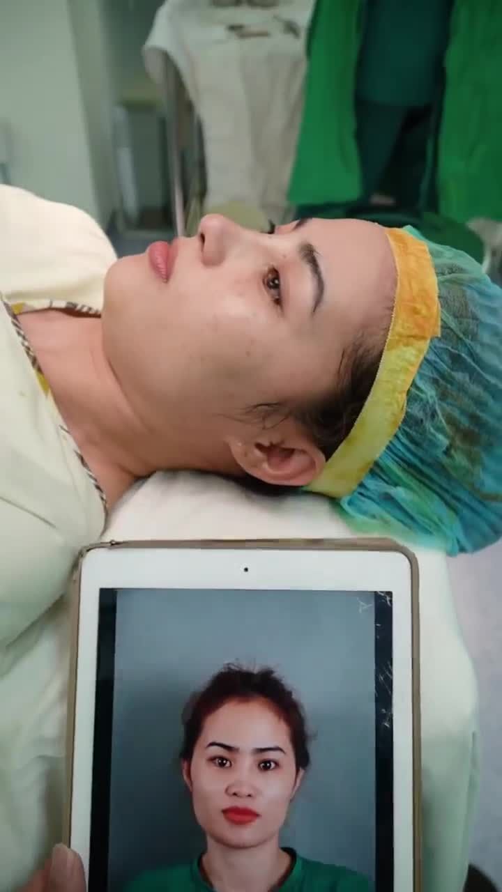 TRẢ KẾT QUẢ SAU 60 PHÚT THỰC HIỆN NÂNG MŨI CẤU TRÚC DR. HOẠT