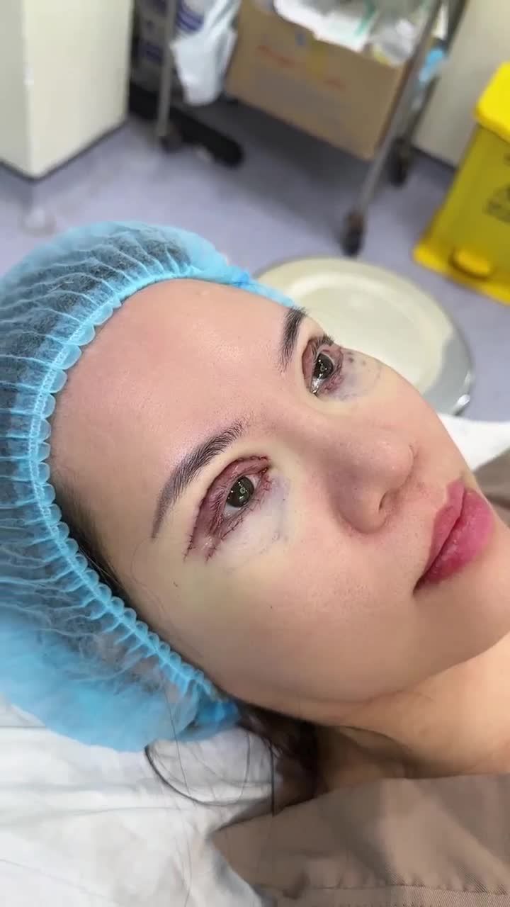 KẾT QUẢ COMBO CẮT MÍ TRÊN + DƯỚI KH. JUAN YI JTEN