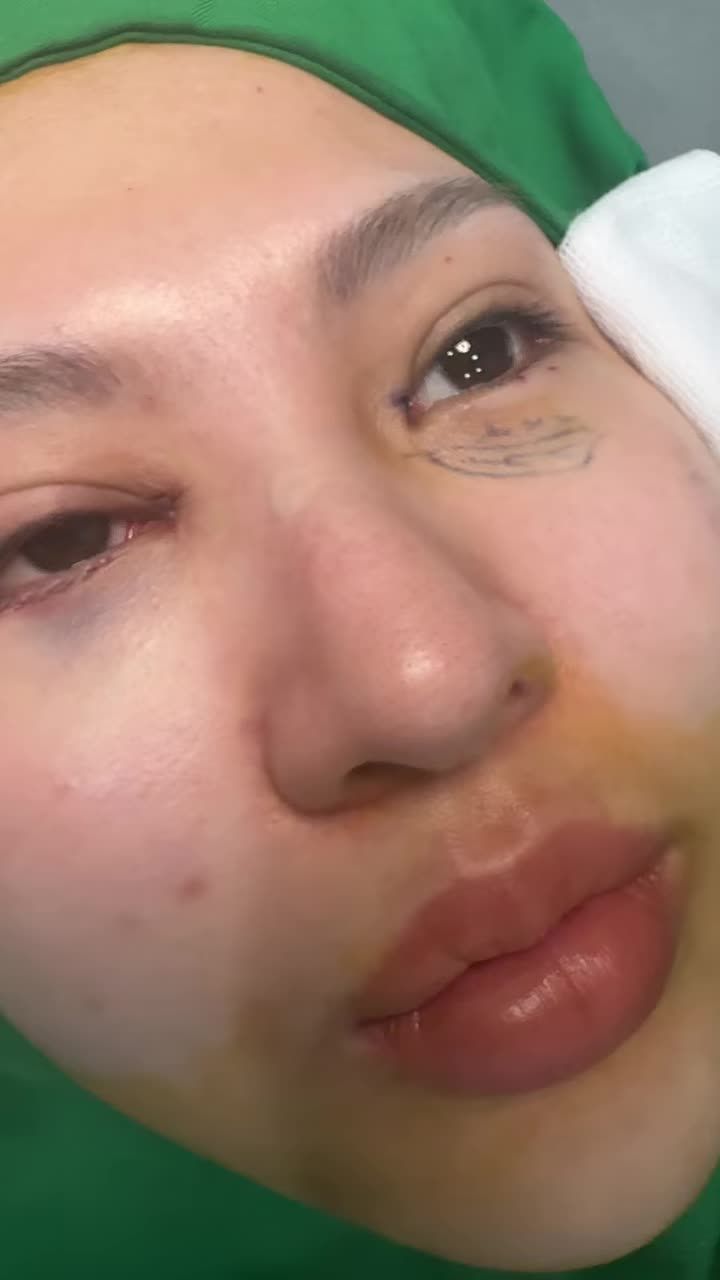 Combo xoá rãnh lệ sâu mí dưới và mở góc mắt trong với Dr Vương