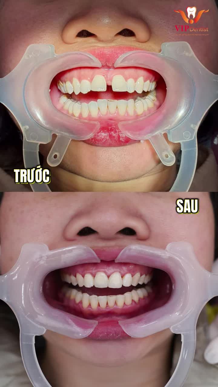 U40 NIỀNG RĂNG: MUỘN CÒN HƠN KHÔNG!