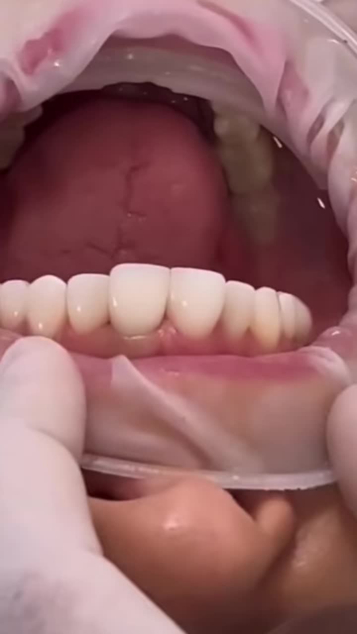 ĐÂY LÀ LÍ DO MẤT RĂNG PHẢI TRỒNG NGAY IMPLANT