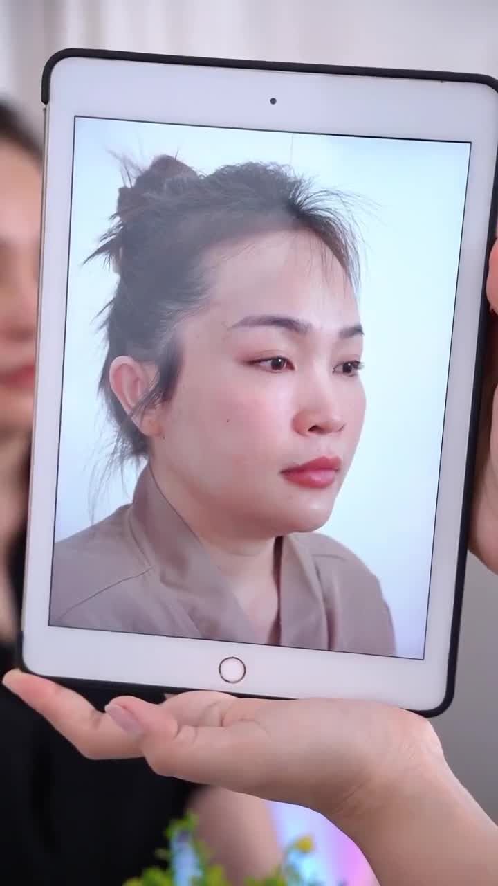 KẾT QUẢ SAU 10 NGÀY NÂNG MŨI CẤU TRÚC SỬA LẠI MŨI HỎNG KH. PHƯƠNG NGUYỄN