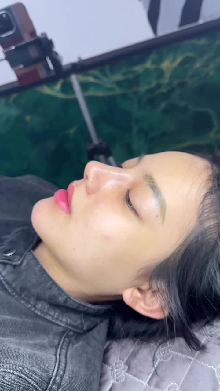 COMBO MŨI CẰM SURGIFORM SAU 10 NGÀY TÁI KHÁM.