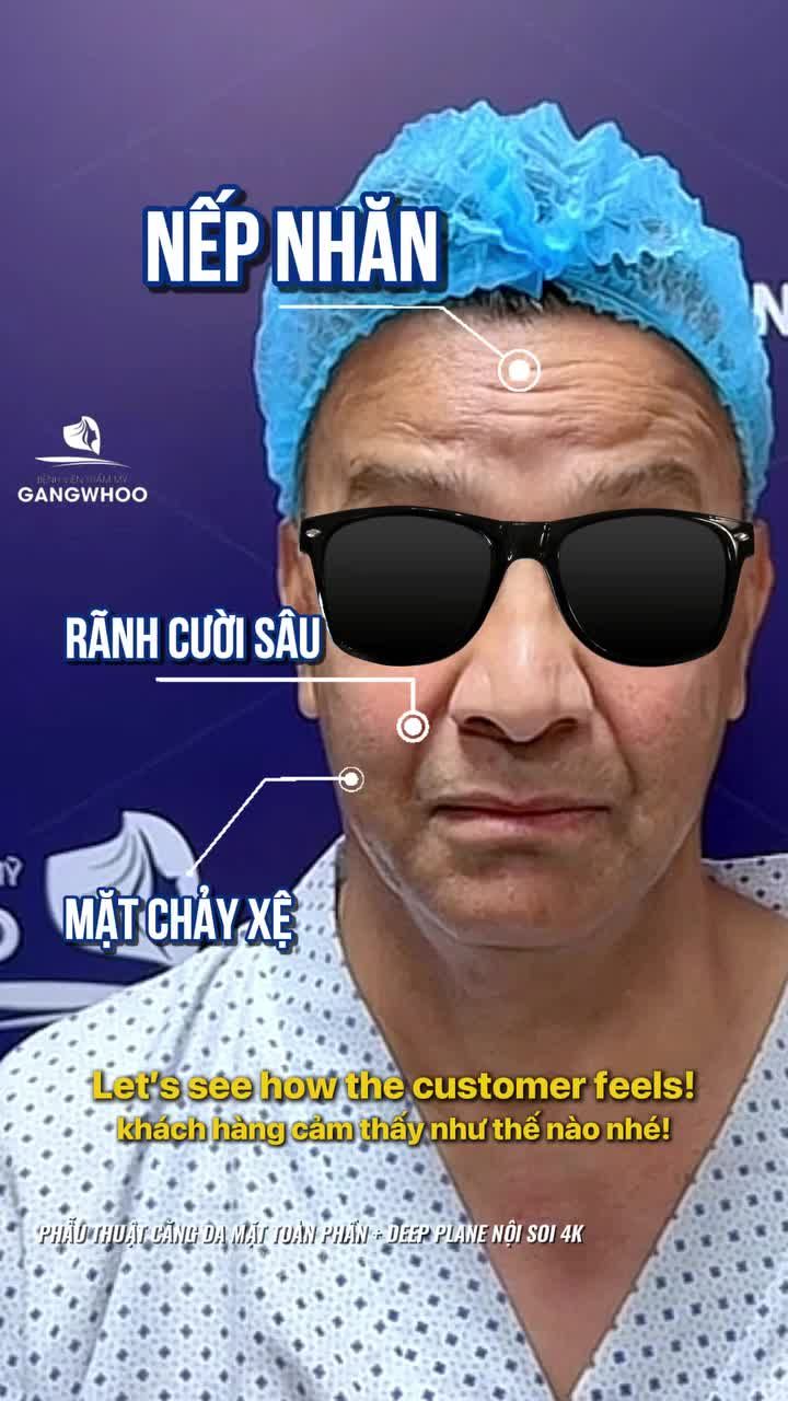 Phẫu thuật căng da mặt toàn phần + Deep Plane nội soi 4K giải quyết mọi vấn đề lão hóa trên làn da