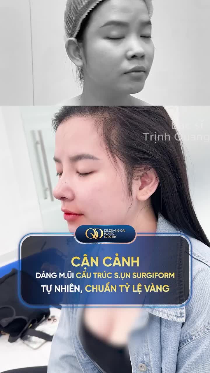 CẬN CẢNH DÁNG MŨI CẤU TRÚC SỤN SURGIFORM TỰ NHIÊN, CHUẨN TỶ LỆ VÀNG