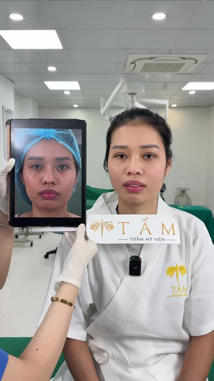 Chị khách đến với TMV Tấm trong tình trạng mắt thiếu mỡ, một bên sụp mí, một bên đa nếp mí khiến tổng thể gương mặt trông mệt mỏi, thiếu sức sống.