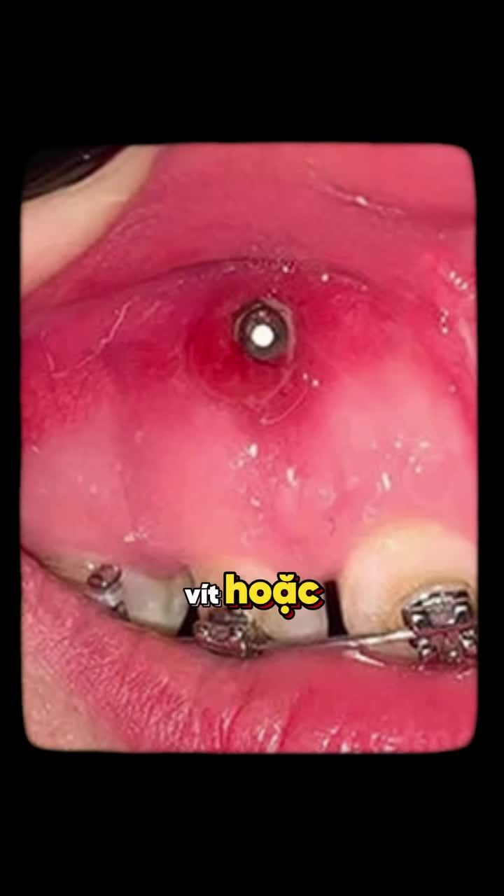 3 CÁCH VỆ SINH MINIVIS TRÁNH VIÊM NHIỄM