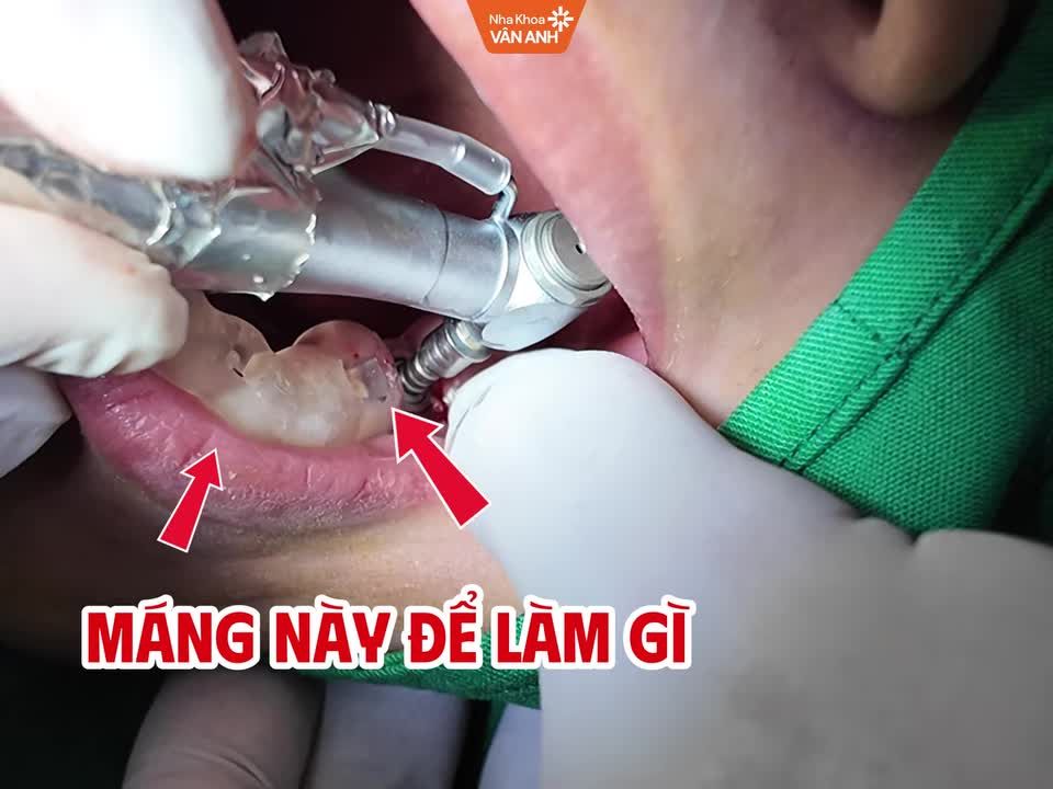 "GPS THẾ HỆ MỚI" - CÔNG NGHỆ ĐỊNH VỊ HISAFE TRONG CẤY GHÉP IMPPLANT   – BÁC SĨ CHUYÊN SÂU CHIA SẺ