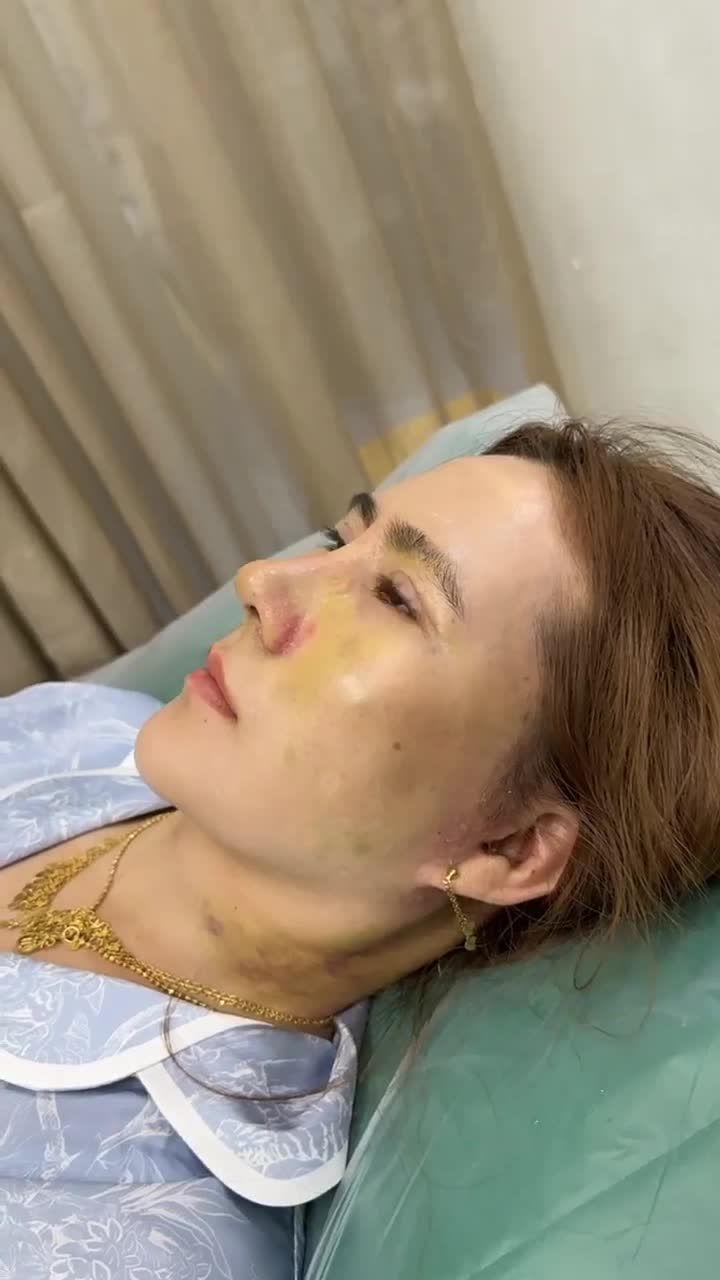KẾT QUẢ NÂNG MŨI SỤN SƯỜN NGAY SAU KHI THÁO NẸP + CẮT CHỈ!!