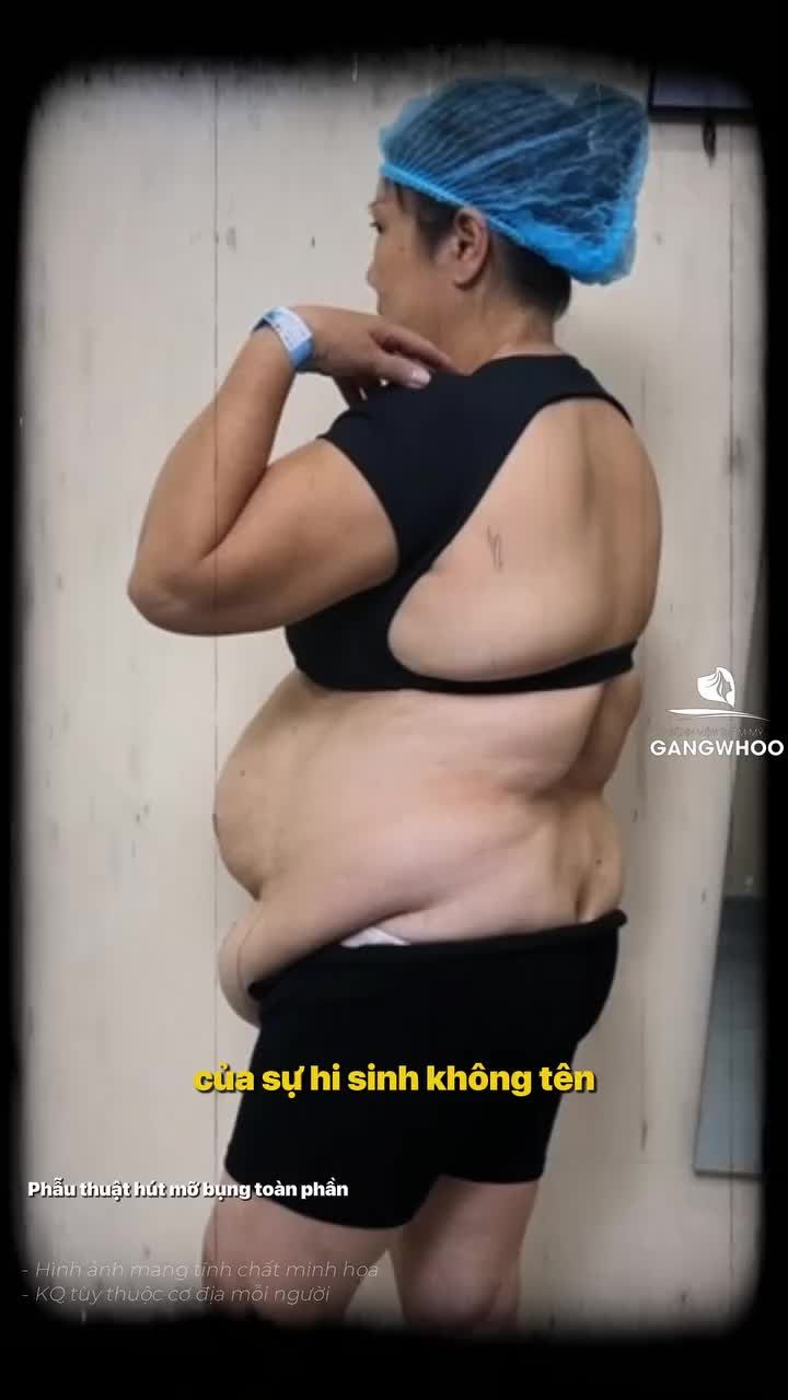 "Chiếc bụng ấy đã theo chị hơn chục năm qua... "- chị khách chia sẻ trải nghiệm sau khi lựa chọn Gangwhoo để trút bỏ gánh nặng ấy!
