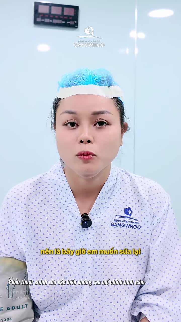 Cấy mỡ/ tiêm filler vùng thái dương có thật sự an toàn như lời đồn?