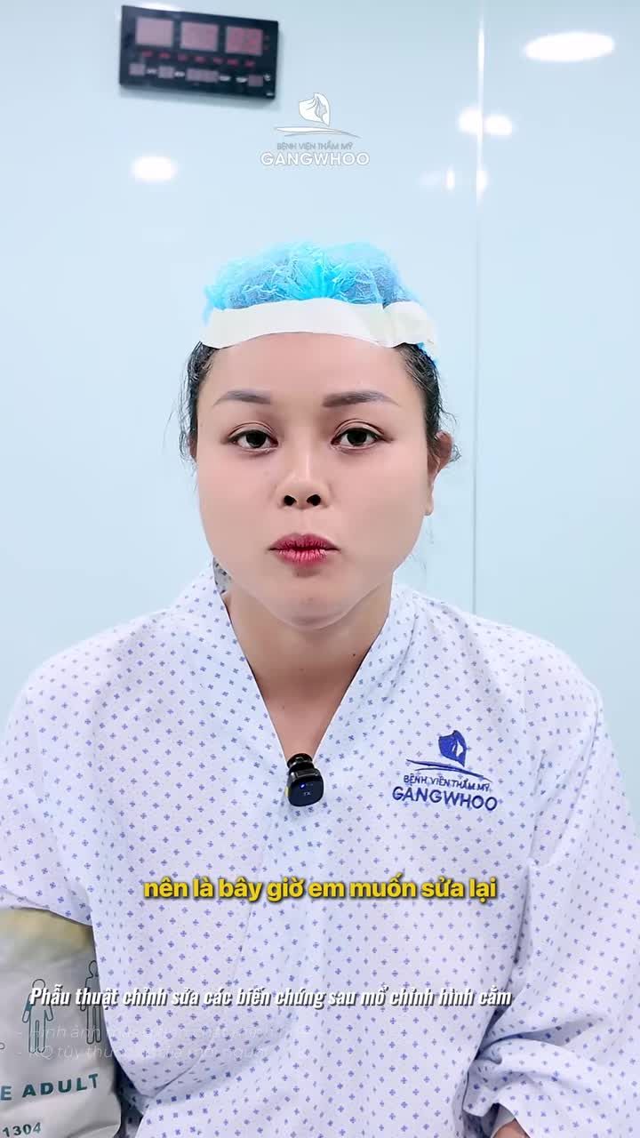 Cấy mỡ/ tiêm filler vùng thái dương có thật sự an toàn như lời đồn?