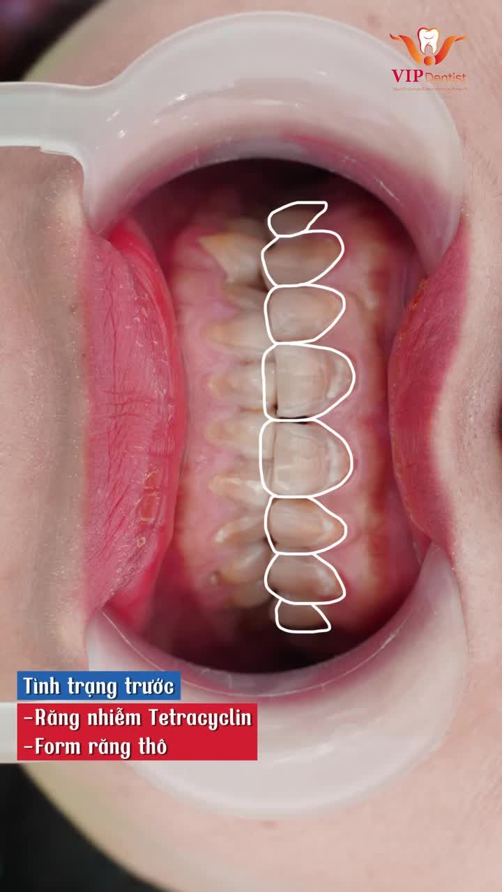Tạm biệt răng nhiễm Tetracycline, đón nụ cười rạng rỡ!