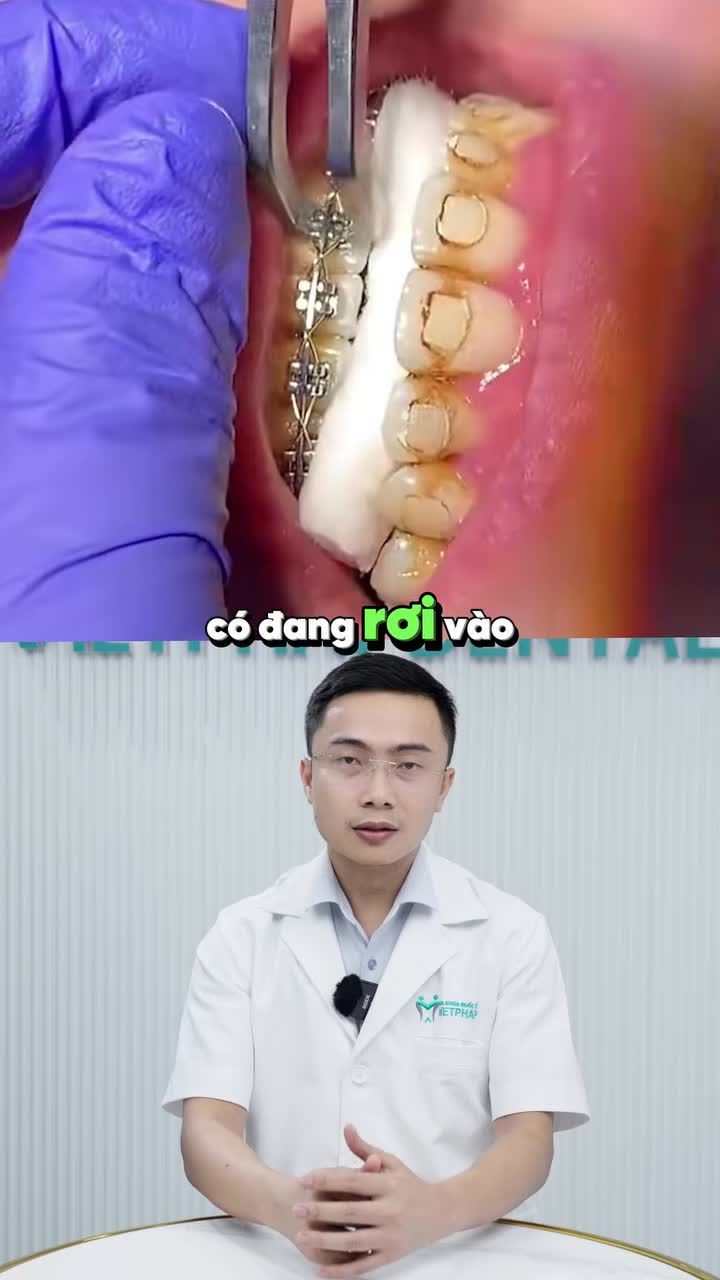 LÝ DO NIỀNG RĂNG BỊ HÔI MIỆNG